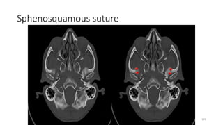 Sphenosquamous suture
135
 