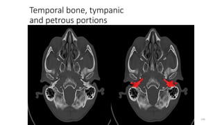 Temporal bone, tympanic
and petrous portions
136
 