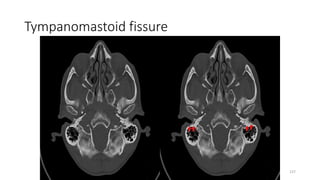Tympanomastoid fissure
137
 