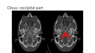 Clivus –occipital part
140
 