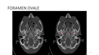 FORAMEN OVALE
141
 