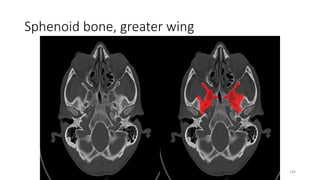 Sphenoid bone, greater wing
144
 