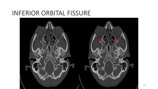 INFERIOR ORBITAL FISSURE
146
 