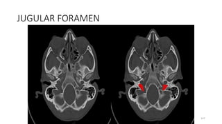 JUGULAR FORAMEN
147
 