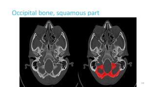 Occipital bone, squamous part
148
 