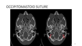 OCCIPITOMASTOID SUTURE
149
 