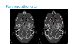 Pterygopalatine fossa
153
 
