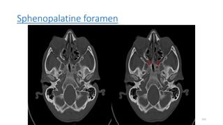 Sphenopalatine foramen
155
 