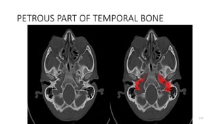 PETROUS PART OF TEMPORAL BONE
157
 