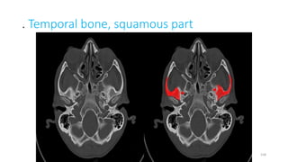 . Temporal bone, squamous part
158
 