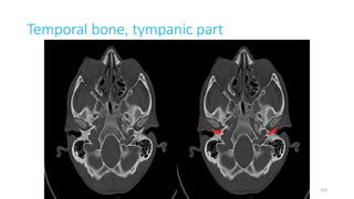 Temporal bone, tympanic part
159
 
