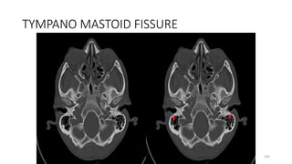 TYMPANO MASTOID FISSURE
160
 