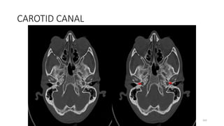 CAROTID CANAL
162
 