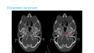 Foramen lacerum
164
 