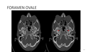 FORAMEN OVALE
165
 