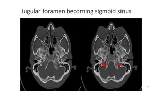 Jugular foramen becoming sigmoid sinus
167
 