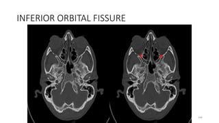 INFERIOR ORBITAL FISSURE
168
 