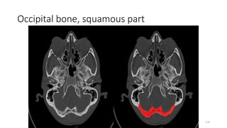 Occipital bone, squamous part
170
 