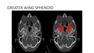GREATER WING SPHENOID
176
 