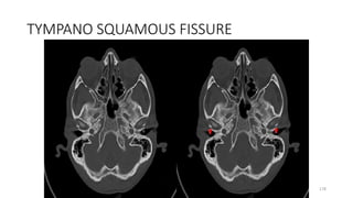 TYMPANO SQUAMOUS FISSURE
178
 