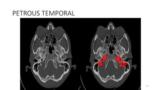 PETROUS TEMPORAL
179
 