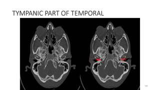 TYMPANIC PART OF TEMPORAL
180
 