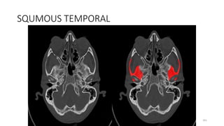 SQUMOUS TEMPORAL
181
 