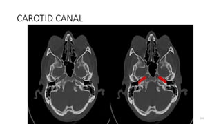 CAROTID CANAL
183
 