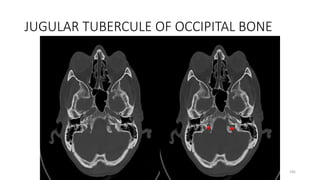 JUGULAR TUBERCULE OF OCCIPITAL BONE
185
 