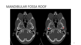 MANDIBULAR FOSSA ROOF
186
 