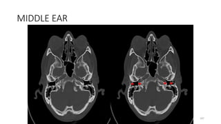 MIDDLE EAR
187
 