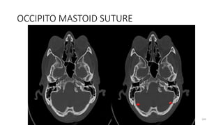 OCCIPITO MASTOID SUTURE
189
 