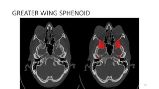 GREATER WING SPHENOID
192
 