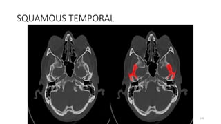 SQUAMOUS TEMPORAL
196
 