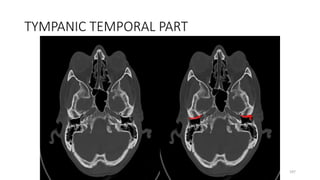 TYMPANIC TEMPORAL PART
197
 