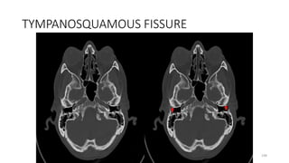 TYMPANOSQUAMOUS FISSURE
198
 
