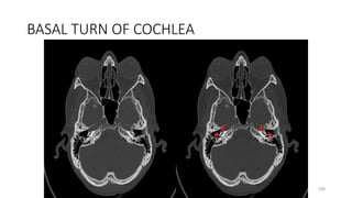 BASAL TURN OF COCHLEA
200
 