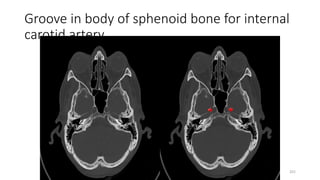 Groove in body of sphenoid bone for internal
carotid artery
201
 