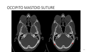 OCCIPITO MASTOID SUTURE
204
 