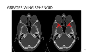 GREATER WING SPHENOID
207
 