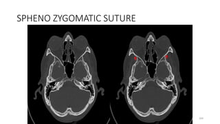 SPHENO ZYGOMATIC SUTURE
209
 