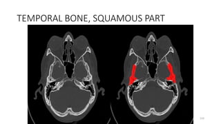 TEMPORAL BONE, SQUAMOUS PART
210
 