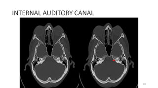 INTERNAL AUDITORY CANAL
213
 