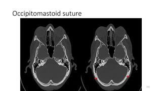 Occipitomastoid suture
216
 