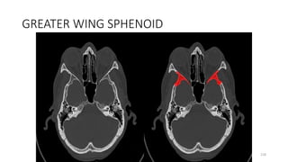 GREATER WING SPHENOID
218
 