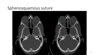 Sphenosquamous suture
220
 
