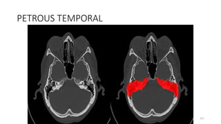 PETROUS TEMPORAL
221
 