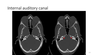 Internal auditory canal
223
 