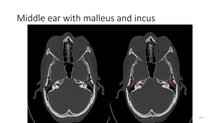 Middle ear with malleus and incus
224
 