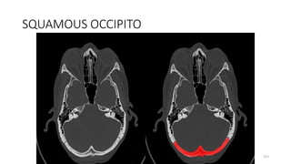 SQUAMOUS OCCIPITO
225
 